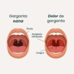 Inflamación Severa de Garganta: Cómo Actuar y Cuándo Buscar Ayuda Médica
