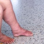 Hinchazón en las Piernas: Cuándo es una Urgencia Médica